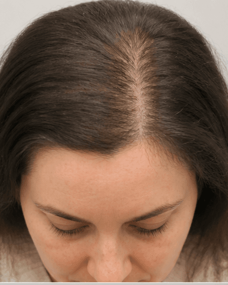 Scalp Mesotherapy: after