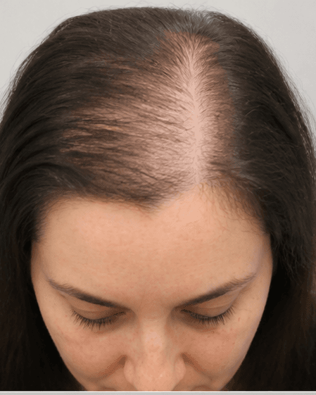 Scalp Mesotherapy: before