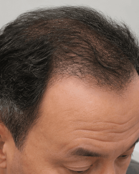 Scalp Mesotherapy: after