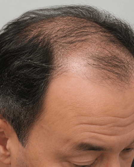 Scalp Mesotherapy: before