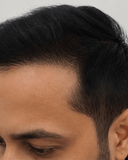 FUE Hair Transplant: after