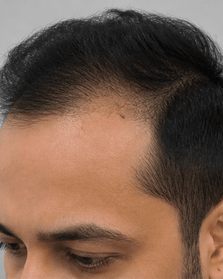 FUE Hair Transplant: before