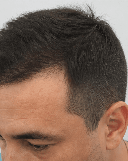 FUE Hair Transplant: after
