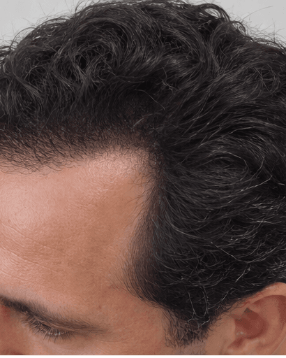 Hairline Design: after