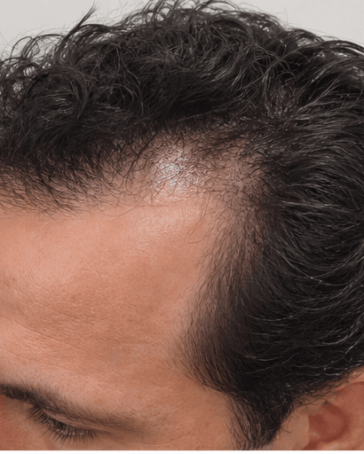 Hairline Design: before