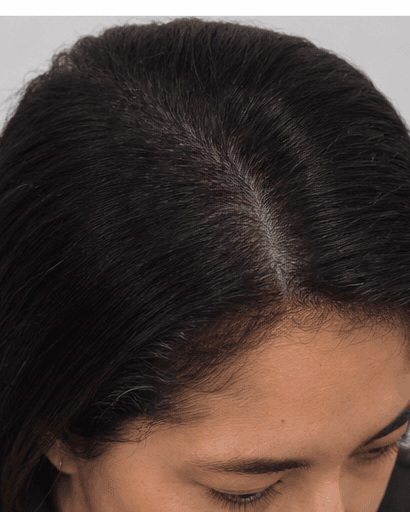 Hairline Design: after