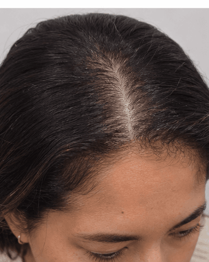 Hairline Design: before