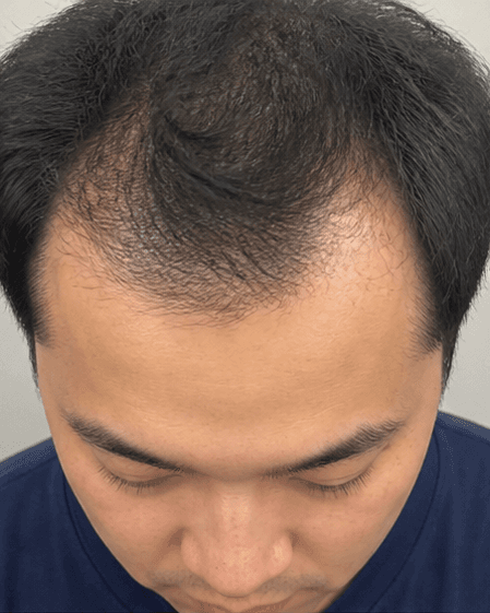 Low-Level Laser Therapy: before