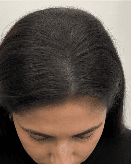 Low-Level Laser Therapy: after