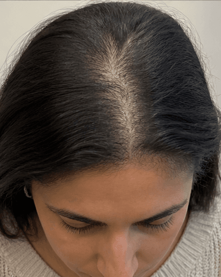 Low-Level Laser Therapy: before