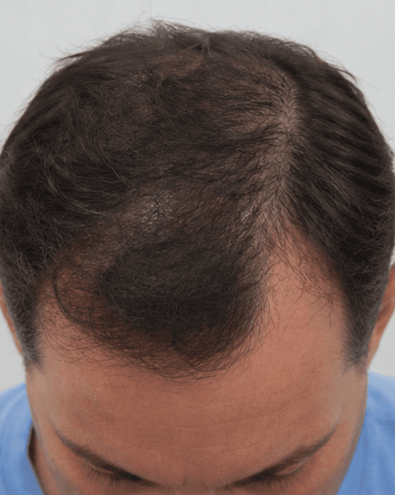 PRP Hair Therapy: after