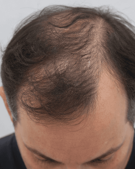 PRP Hair Therapy: before