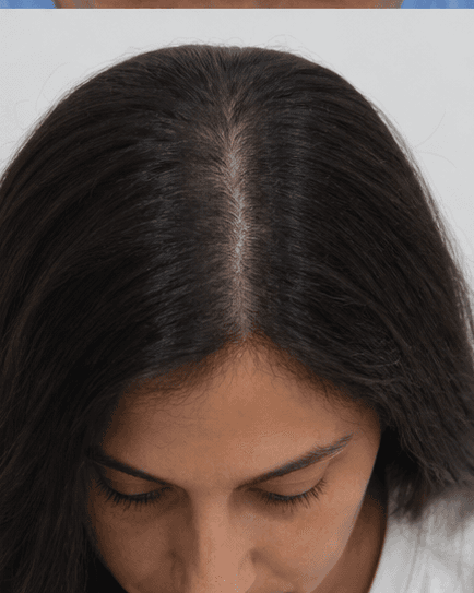 PRP Hair Therapy: after