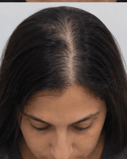 PRP Hair Therapy: before