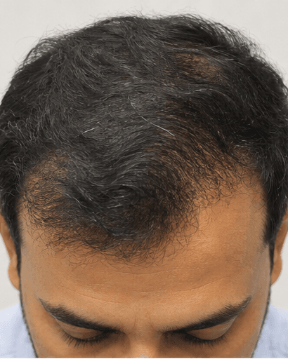 PRP Scalp Therapy: after