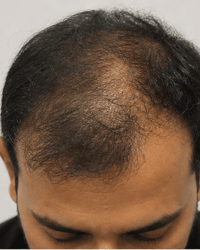 PRP Scalp Therapy: before