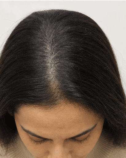PRP Scalp Therapy: after