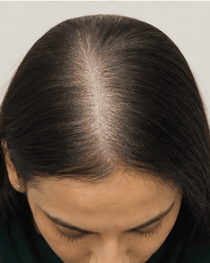 PRP Scalp Therapy: before