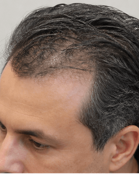Clinical Scalp Detox: after