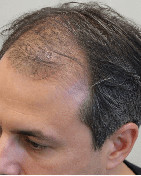 Clinical Scalp Detox: before