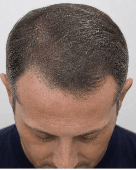 Scalp Micropigmentation: after