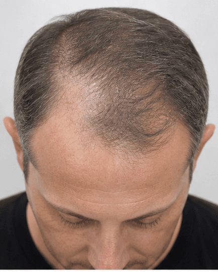 Scalp Micropigmentation: before