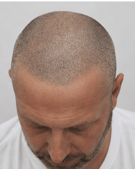 Scalp Micropigmentation: after