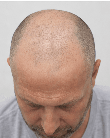 Scalp Micropigmentation: before
