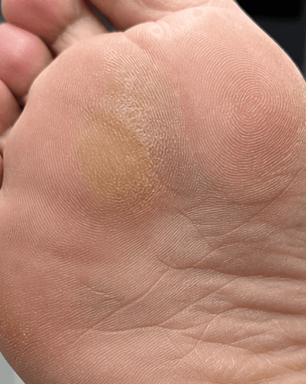 Callus & Corn Management: before