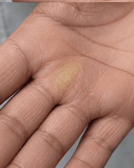 Callus & Corn Management: before