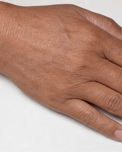 Hand Pigmentation Treatment: after