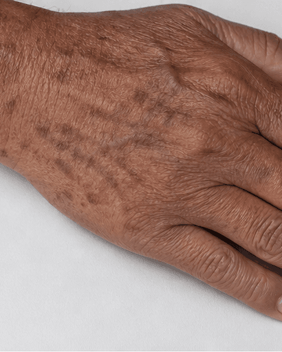 Hand Pigmentation Treatment: before