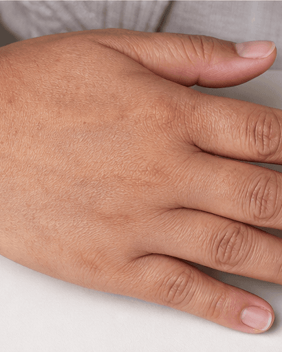 Hand Pigmentation Treatment: after