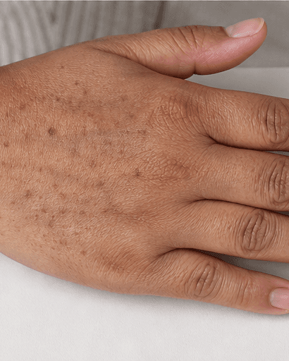 Hand Pigmentation Treatment: before