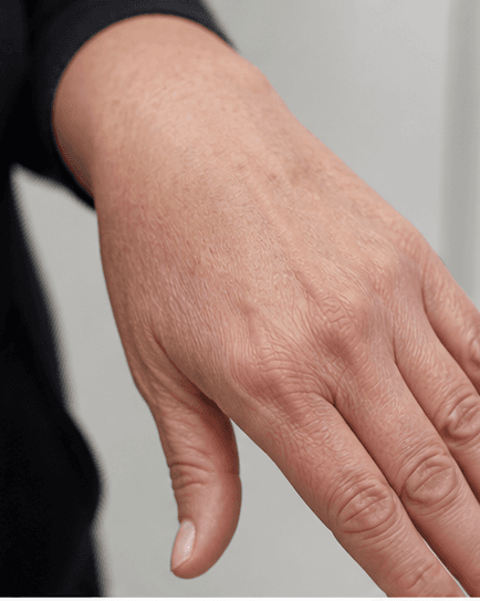 Hand Volume Restoration: after