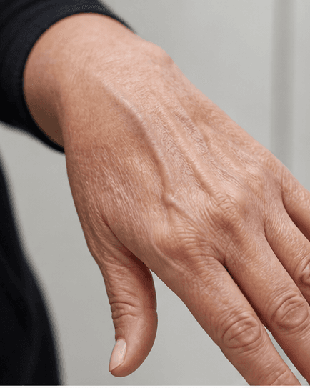 Hand Volume Restoration: before