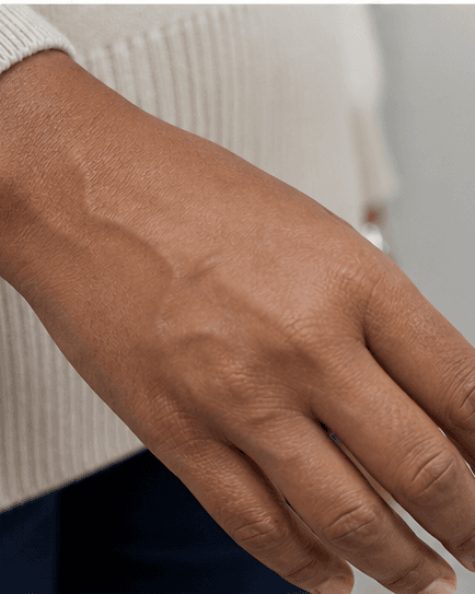 Hand Volume Restoration: before