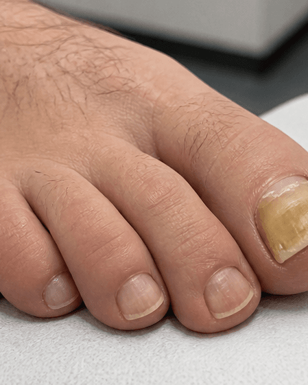 Nail Fungus Laser: before