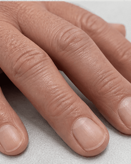 Nail Fungus Laser: after