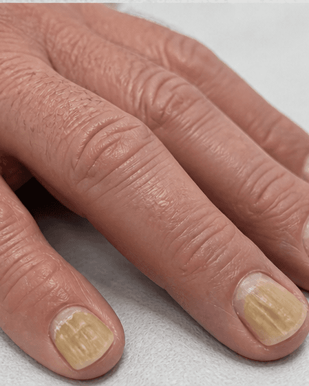 Nail Fungus Laser: before