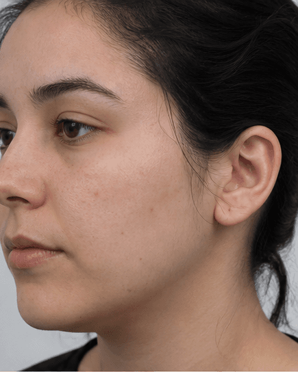 Carbon Laser Peel: after