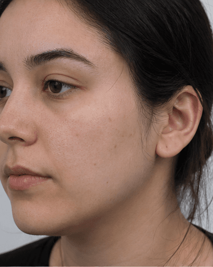Carbon Laser Peel: before