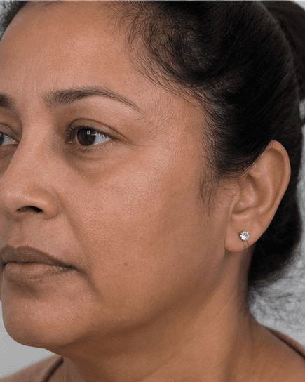 Carbon Laser Peel: after