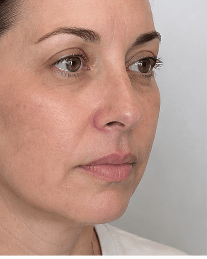 Non-Ablative Fractional Laser: after
