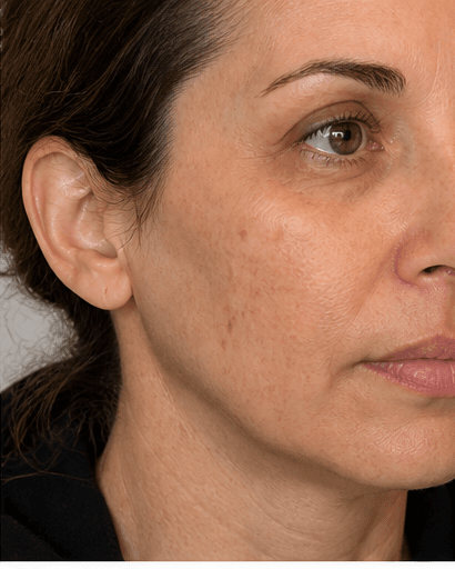 Non-Ablative Fractional Laser: before