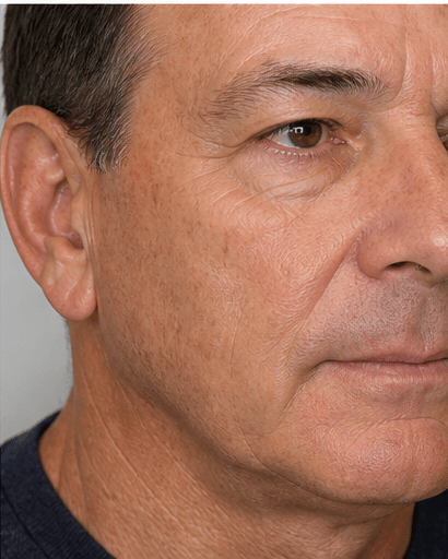 Non-Ablative Fractional Laser: before