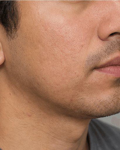 Fractional Resurfacing: after