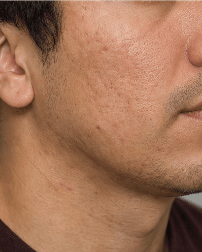 Fractional Resurfacing: before