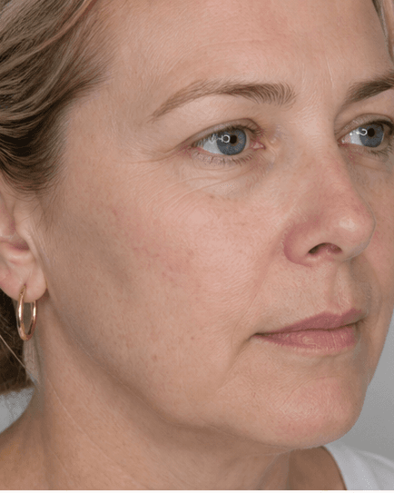 IPL Photofacial: after