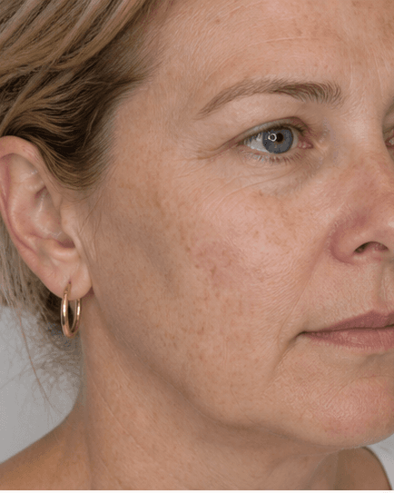 IPL Photofacial: before